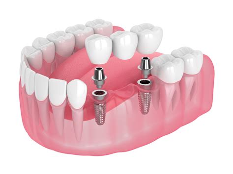 bridge implant in ashford|Top.
